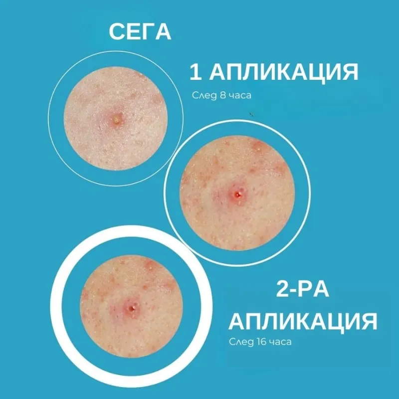 Iroha SOS Pimple Patches with Salicylic Acid — 2