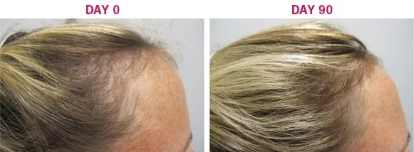 Viviscal 3-month hair loss and growth program for women — 3