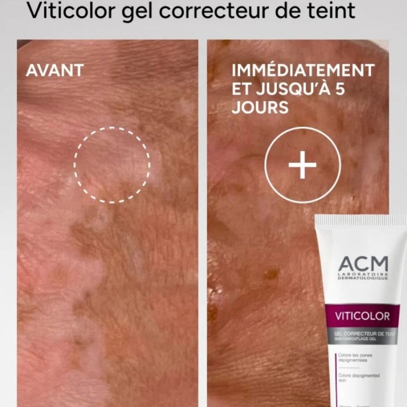 Камуфлажен гел за витилиго и депигментирани зони с DHA и Erythrulose ACM Viticolor Complexion Correcting Gel 50 ml — изглед 4